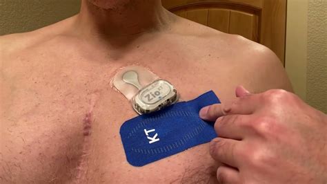 How does your solution work The Zio Patch is a small, flexible, water-resistant, adhesive monitoring patch that records heart rhythms continuously for up to two weeks. . How does zio patch work